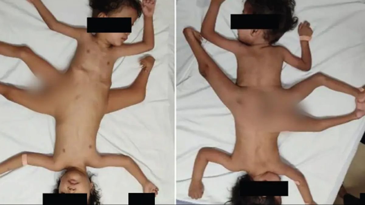 Rare conjoined ‘spider twins’ born in Indonesia with four arms, three legs