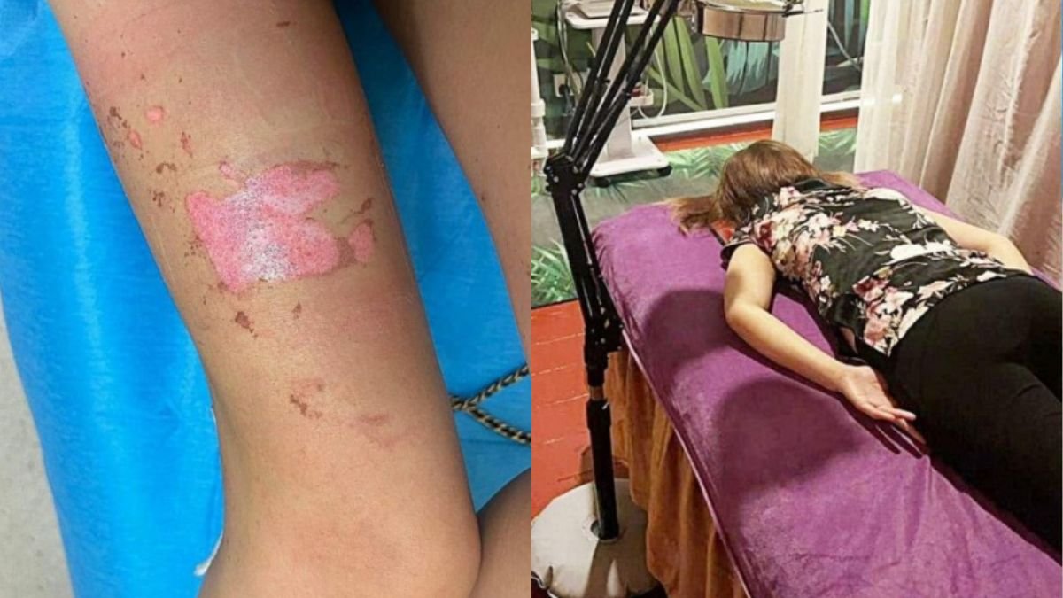 Woman Suffer Burns From TCM Treatment; Bugis Massage Parlour Denies Negligence